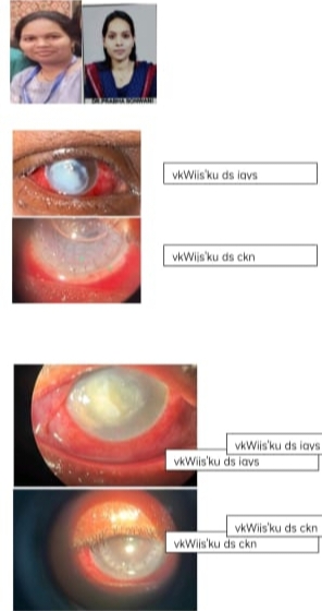 नेत्रदान से मिली रोशनी सिम्स में हुआ कॉर्निया प्रत्यारोपण का 4 सफल ऑपरेशन